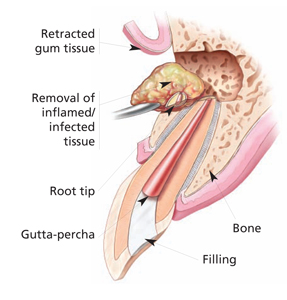 Cross-section showing an apicoectomy: the gum is reflected, the inflamed tissue and root tip are removed, and the end of the canal is sealed with a filling.