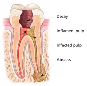 Cross-section of a molar showing how untreated decay reaches the pulp, inflaming and then infecting it, with an abscess forming at the root tip.