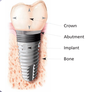 Cross-section of a dental implant in the jawbone, labelling the crown, the abutment, the implant post, and the surrounding bone.