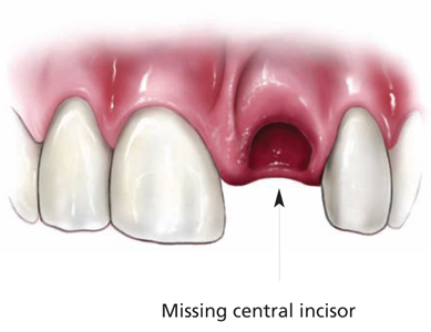 Front view of the upper teeth with a gap where a central incisor is missing.