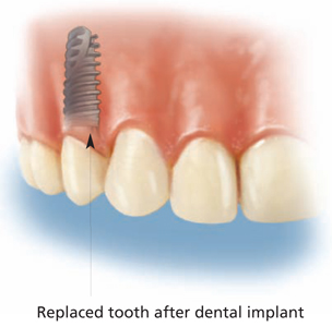 Front view of the upper teeth after an implant has been placed to replace a missing tooth.