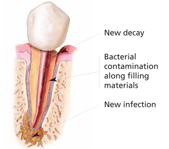 Cross-section of a previously root-canal-treated tooth showing new decay, bacterial contamination along the old filling materials, and a new infection at the root tip.