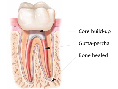 Cross-section of a tooth after root canal treatment, with the cleaned canals filled with gutta-percha, a core build-up restoring the crown, and the surrounding bone healed.